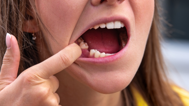A woman pointing to the area of her gums that is healing after a tooth extraction
