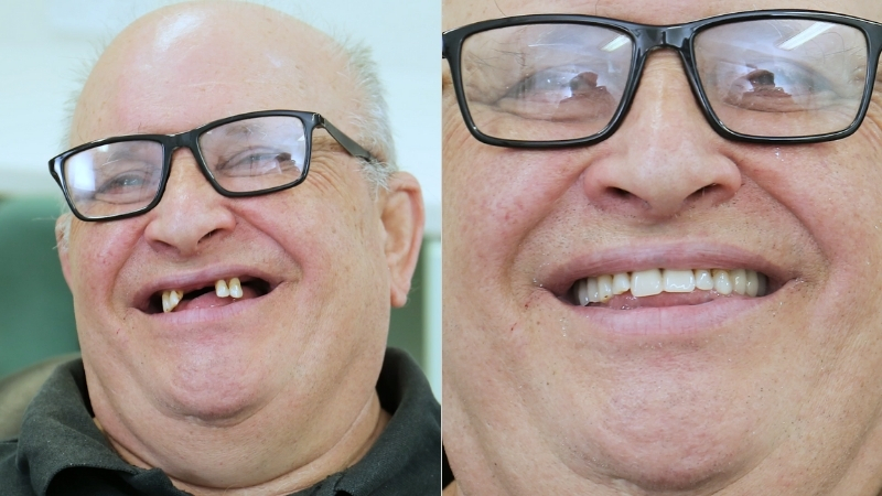 Man shows a before and after smile after replacing missing teeth