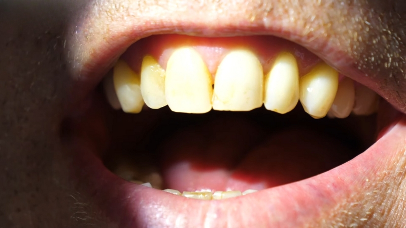 Yellow teeth on an adult mouth with visible staining