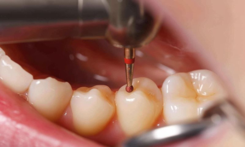 Close-up of a dental drill precisely targeting a molar during a procedure