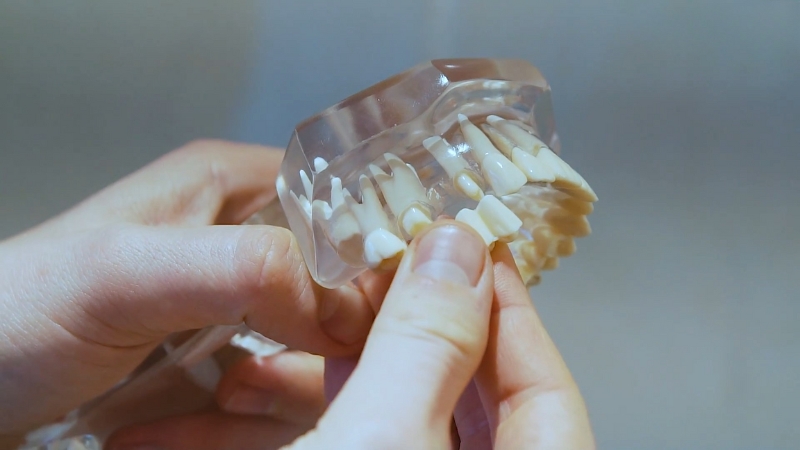 Dental model with a bridge being placed by hand