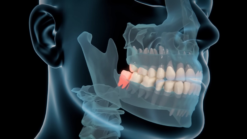 A side view X-ray shows a lower wisdom teeth pushing against the back molar