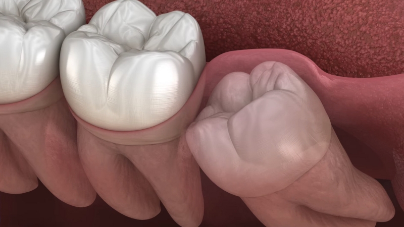 A close view shows an impacted wisdom tooth pushing against the molar in front of it
