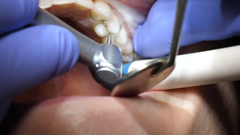 A Dentist Performing a Tooth Filling Procedure on A Patient