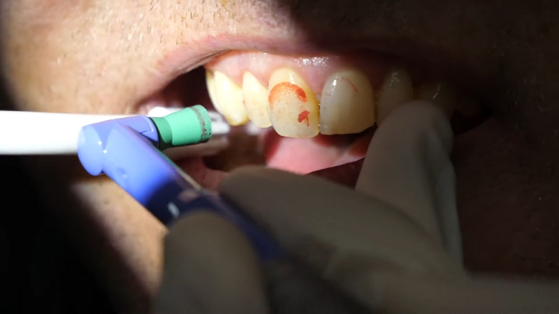 A dentist cleans stained front teeth with a polishing tool