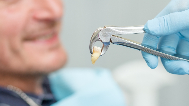 A dentist holds a freshly removed tooth with metal extraction forceps