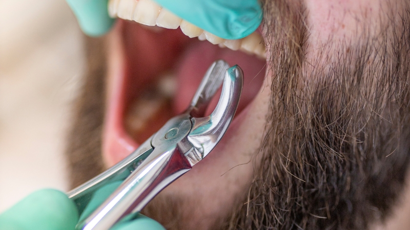 A dentist using forceps to remove a tooth during a tooth extraction procedure