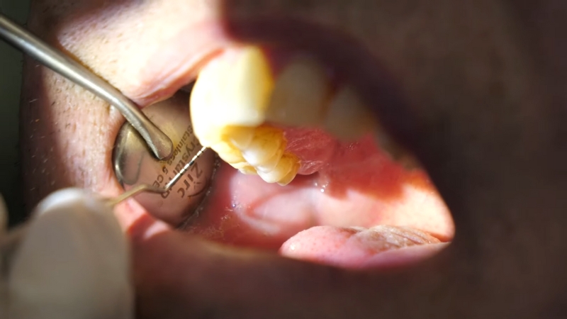 A dentist examines heavily stained teeth with a mirror and probe