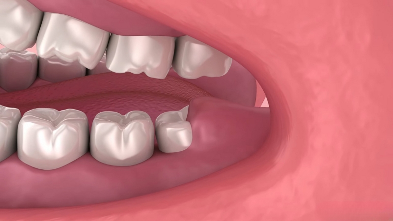A close view of lower molars with the area where a wisdom tooth grows
