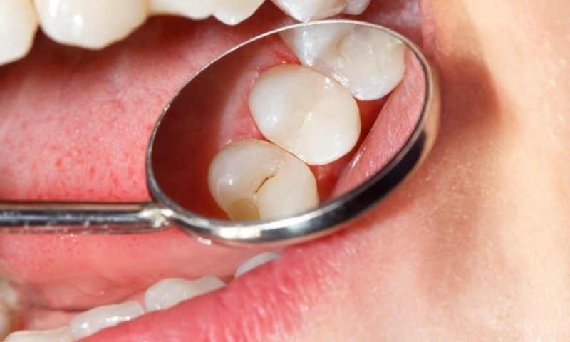 Close-up view of a dental mirror examining two molars, revealing a subtle crack on the lower tooth surface