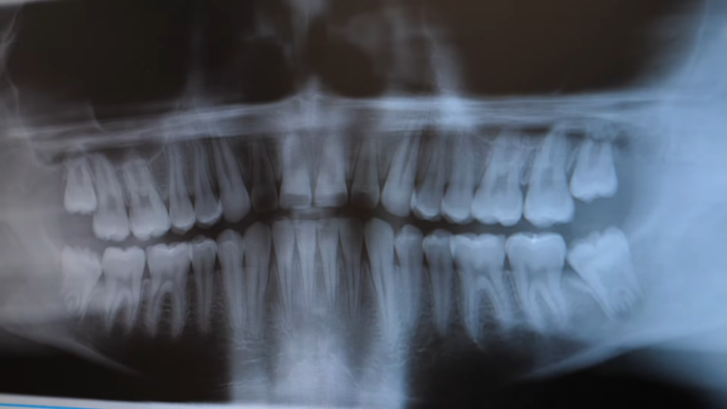 The Dental X-Ray Shows a Detailed View of The Patient's Upper and Lower Teeth,