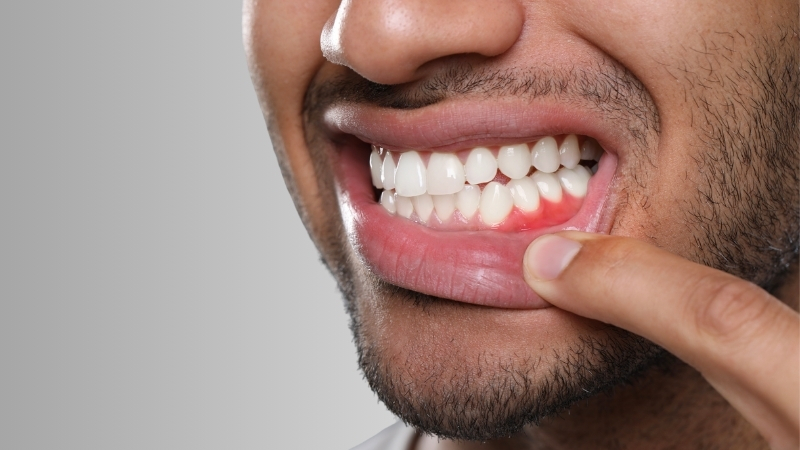 Red gum area on a man’s lower jaw that shows classic gingivitis irritation