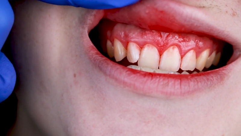 Red, swollen upper gums on a patient during a dental check